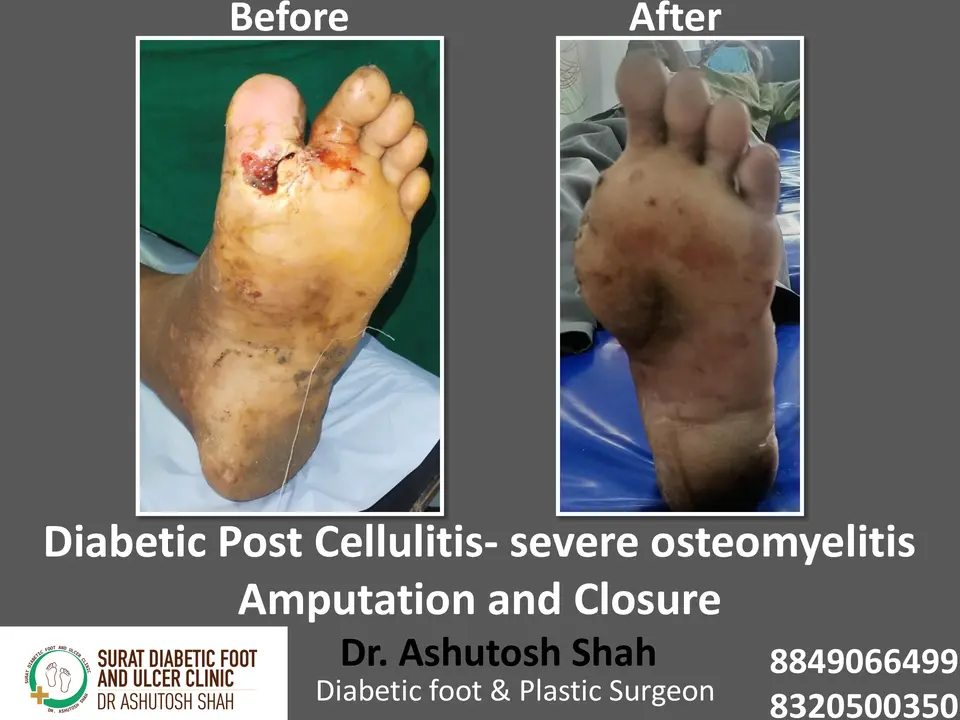 Diabetic Foot  PPT sunita.pptx-11.webp